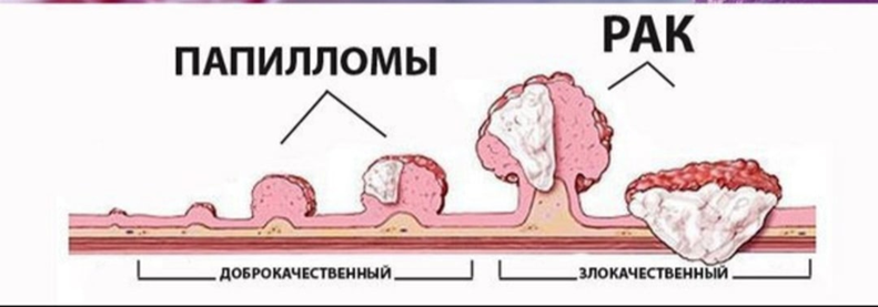 папилломавирус 2